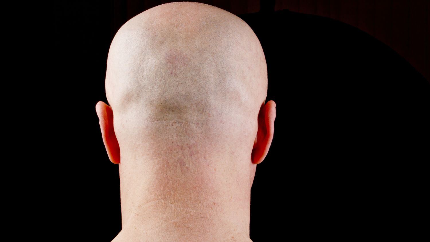 A bald man's head from the back (Image: Dreamstime)